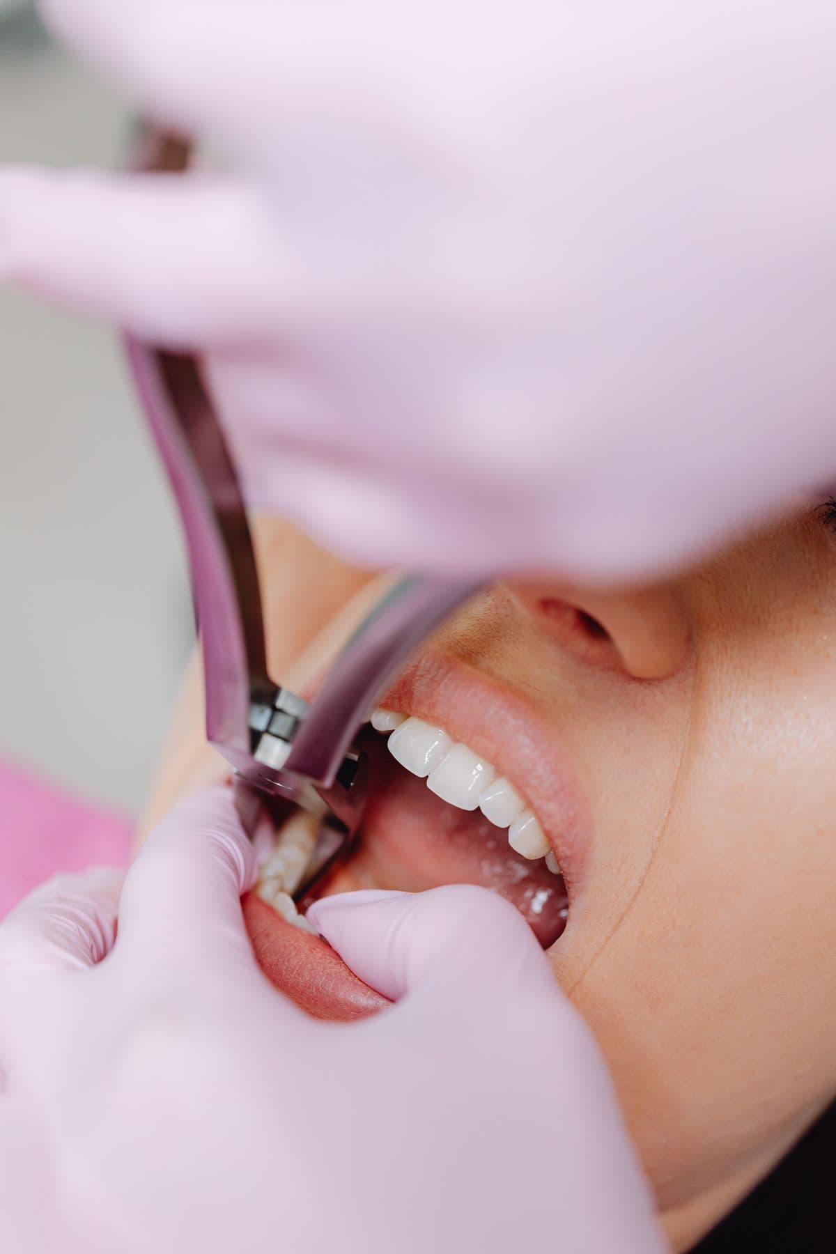 Tooth Extraction & Wisdom Tooth Removal